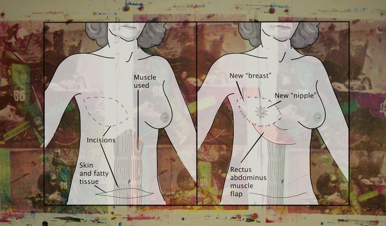 Tissue Reconstruction