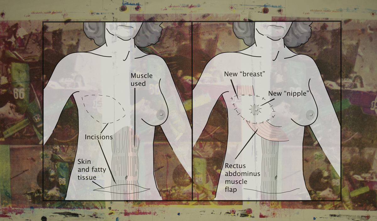 Tissue Reconstruction