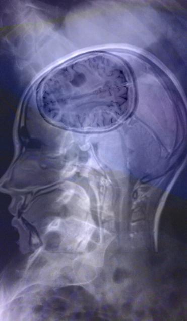 Spine and brain