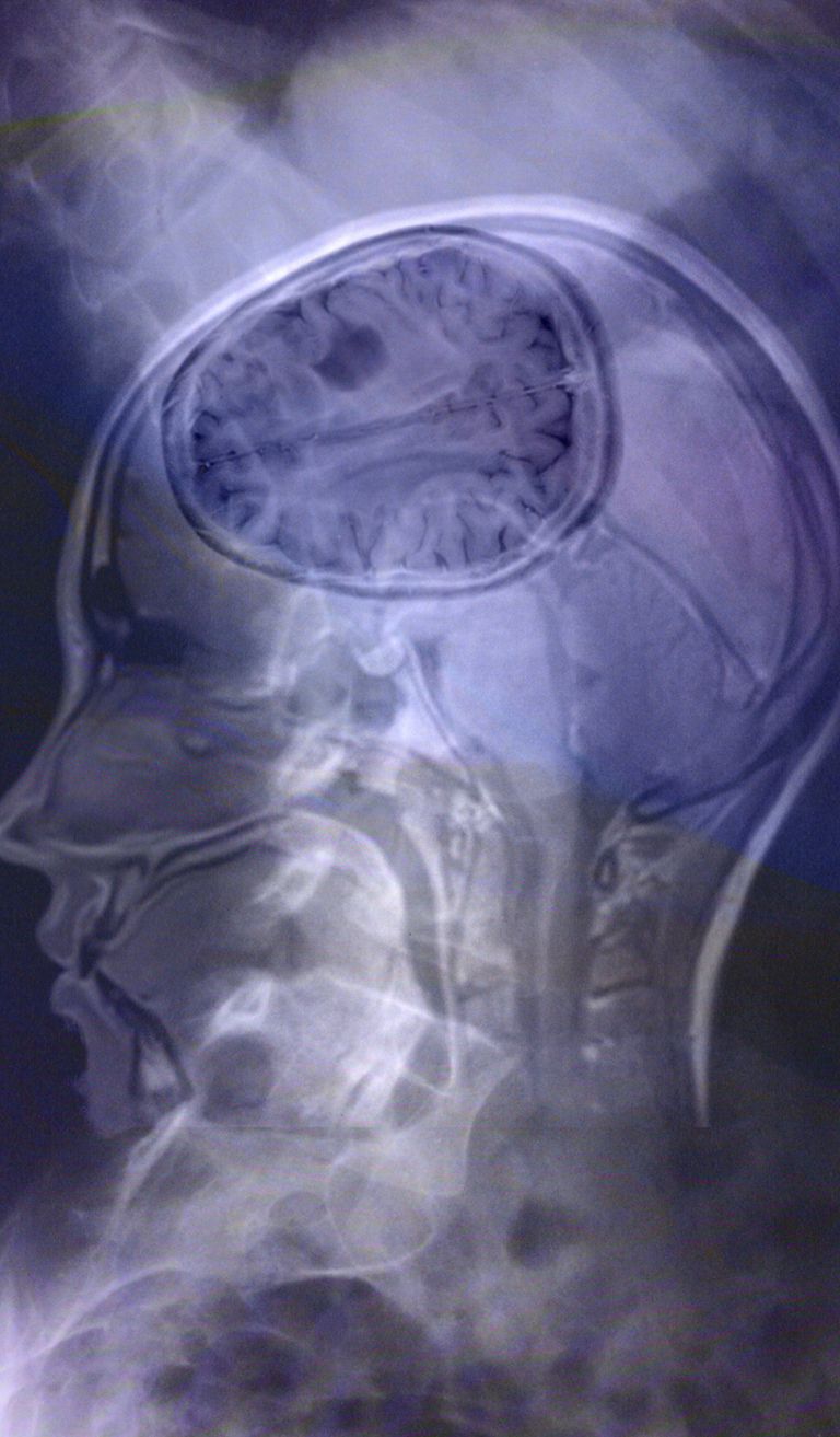 Spine and Brain