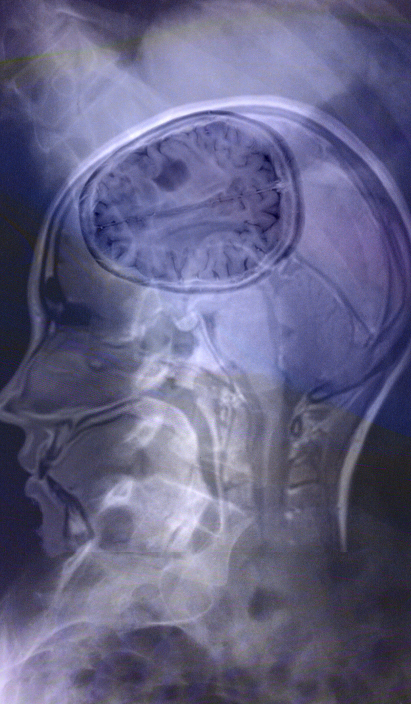 Spine and Brain